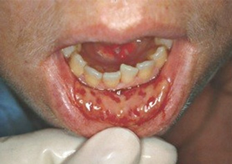 How it Works img mouth 2 - How it Works