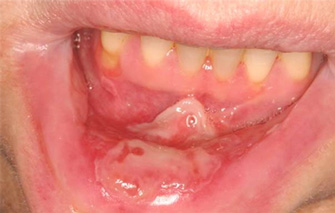 How it Works img mouth 3 - How it Works