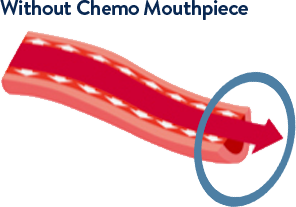 The True Cost of Chemo-Induced Oral Mucositis img without chemo mouthpiece - The True Cost of Chemo-Induced Oral Mucositis